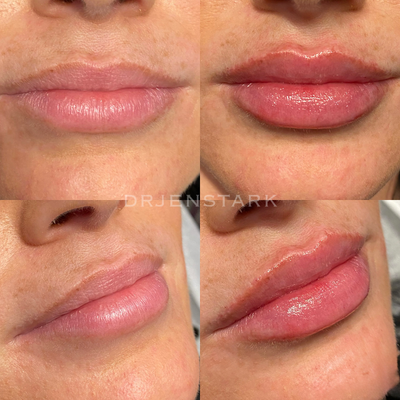 Dermal Fillers before and after photo