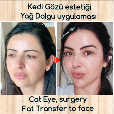 Deep Plane Facelift before and after photo
