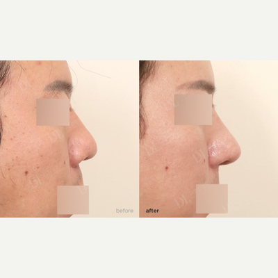 Revision Rhinoplasty before and after photo