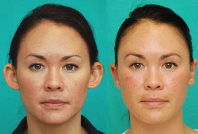 Ear Surgery before and after photo