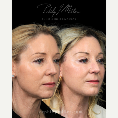 Facelift before and after photo