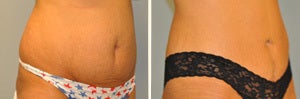 Tummy Tuck before and after photo