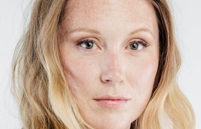 Brow Lift