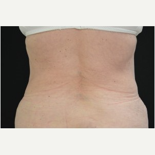 Tummy Tuck Vs. Coolsculpting: Which Should You Choose? - Thaxton