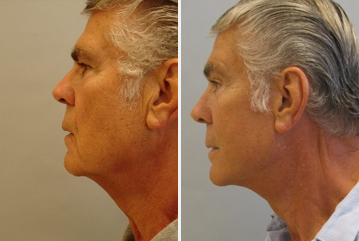 Facial Fat Transfer before and after photo