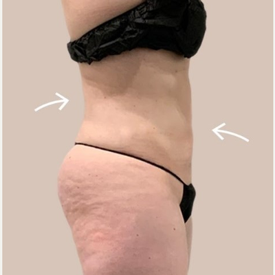 Bellevue-Seattle Liposuction  Liposuction Body Contouring in Seattle, WA