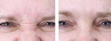 Botox before and after photo