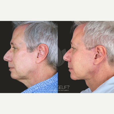 before and after image