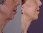 Chin Implant before and after photo
