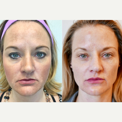 Dermal Fillers before and after photo