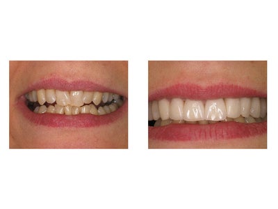 Porcelain Veneers before and after photo