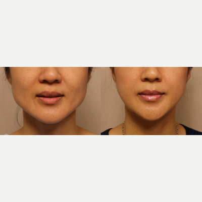 Jaw Reduction before and after photo