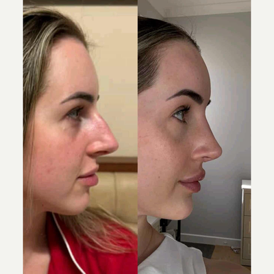 Lip Fillers before and after photo