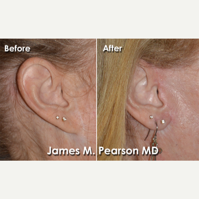 Earlobe Repair before and after photo