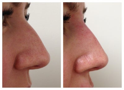 Restylane Lyft before and after photo