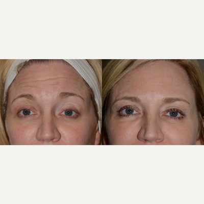 Botox before and after photo
