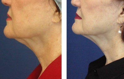 Skin Tightening before and after photo