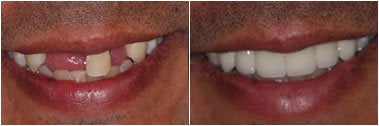 Dental Implants before and after photo