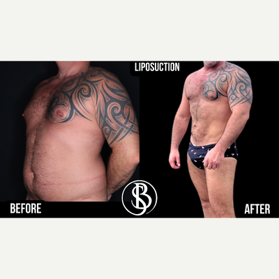 Liposuction before and after photo