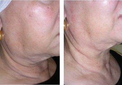 Thermage before and after photo