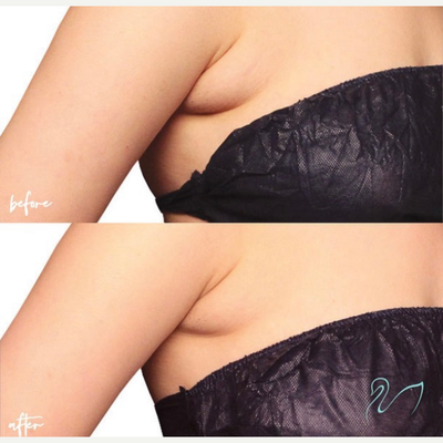 CoolSculpting before and after photo