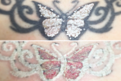 PicoSure before and after photo