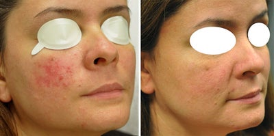 Pulsed Dye Laser before and after photo