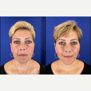 Facelift before and after photo