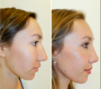 Rhinoplasty before and after photo