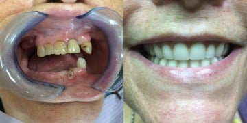 Smile Makeover before and after photo