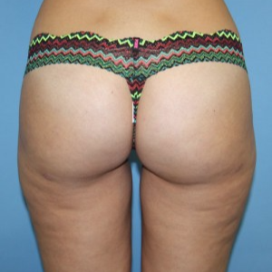 Covid-19 and Brazilian Butt Lift Procedure - Dr. Cat Begovic