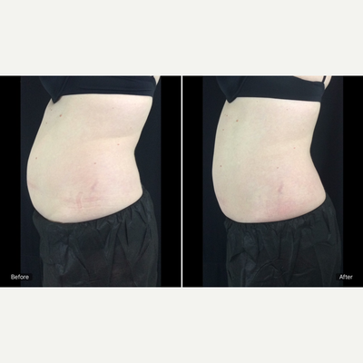 Vanquish before and after photo