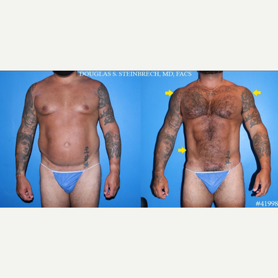 Liposuction before and after photo