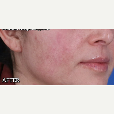 How Much Does Generic Accutane Cost