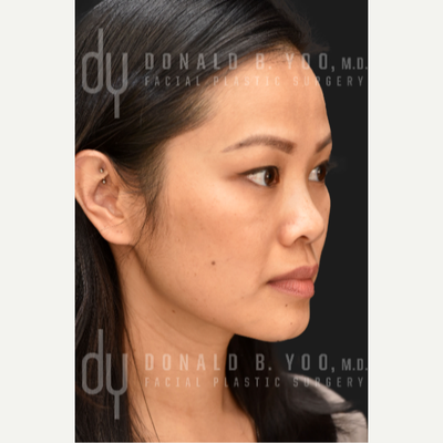 Beverly Hills Facial Plastic Surgery – Donald B. Yoo M.D.