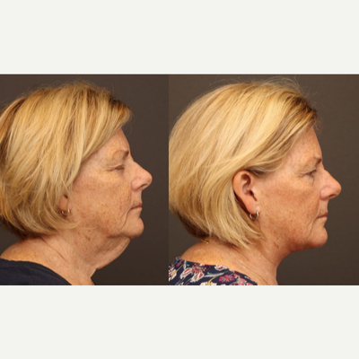 Neck Lift before and after photo