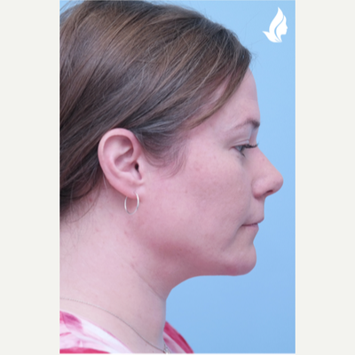 Buccal Fat Removal after 12822341 5695503