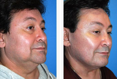 Cheek Lift before and after photo