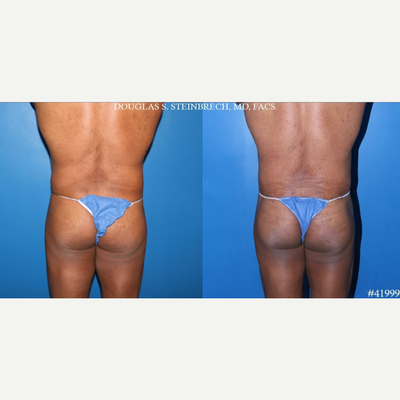 Butt Implants before and after photo