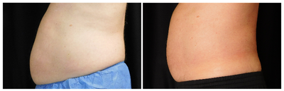 CoolSculpting before and after photo