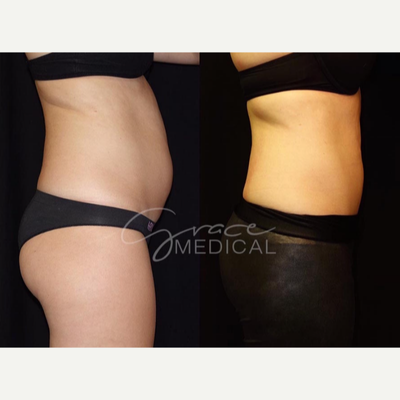 CoolSculpting before and after photo