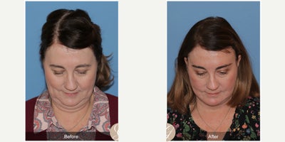 63 year old woman treated with Deep Plane Facelift, Facelift, Neck Lift, Brow Lift, MACS Facelift - 63 year old woman treated with Deep Plane Face and Neck Lift, Temporal Brow Lift, MAC