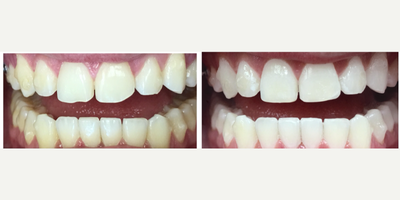 18-24 year old man treated with Dental Bonding - Patient came in after his Invisalign treatment was done to correct chipping on central teeth. Patient also wanted to brighten smile. After doing 3 sessions of Zoom whitening bondingand recontouring was done on central teeth. Patient is completely happy with the final touches to his smile.