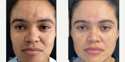 25-34 year old woman treated with Pico Genesis, DiamondGlow - Combo therapies in action! Pico Genesis combined with DiamondGlow Facials to address pigment, melasma and texture.