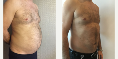 35-44 year old man treated with Liposuction on Chest and Abdomen area - Liposuction on Chest and Abdomen area - The result of 5 months