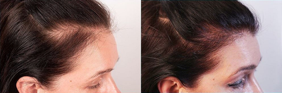 Patient treated with Nutrafol - Take control of thinning hair with Nutrafol! Physician formulated with clinically tested botanical ingredients. 
