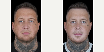 Man treated with Jaw Surgery, Genioplasty - Patient James John Jones shares his experience with Double jaw surgery, genioplasty, and hospitaprime.