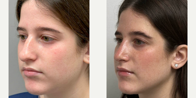 Woman treated with Rhinoplasty - Rhinoplasty