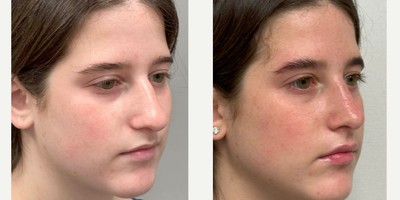 Woman treated with Rhinoplasty - Rhinoplasty
