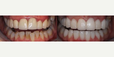 Woman treated with Tooth Repair - Woman treated with Tooth Repair through use of veneers (20 porcelain restorations) crowns, bridges and gum lift for full mouth rehabilitation.